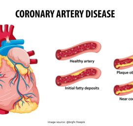 توضح الشريان التاجي وتصلبه