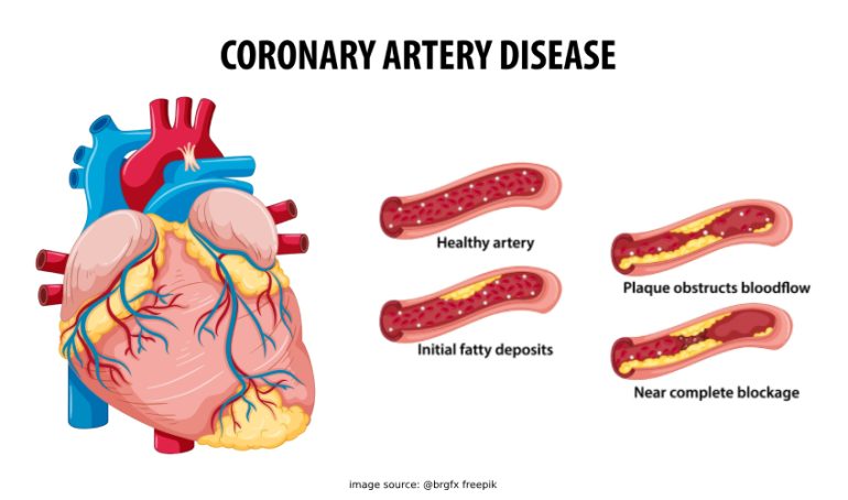 توضح الشريان التاجي وتصلبه